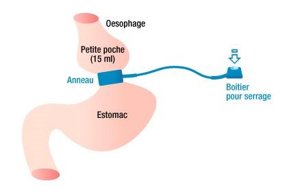 anneau-gastrique.jpg